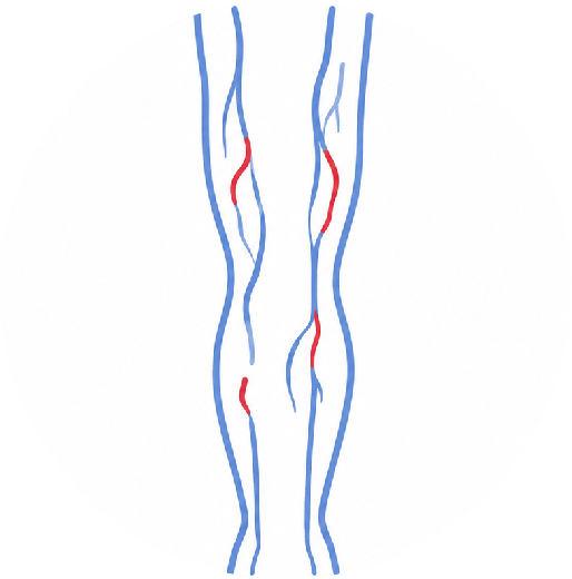 DVT